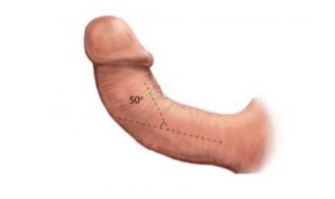 Penile Curvature